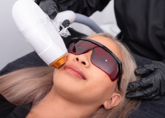 Diode ICE laser hair removal